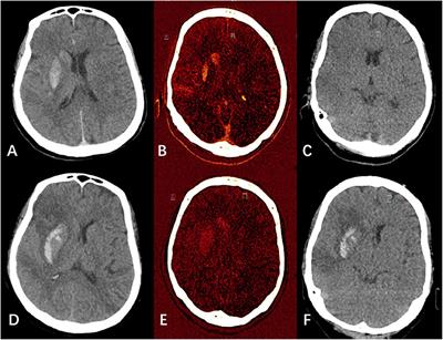 The Role of Dual Energy CT in Evaluating Hemorrhagic Complications at Different Stages After Thrombectomy